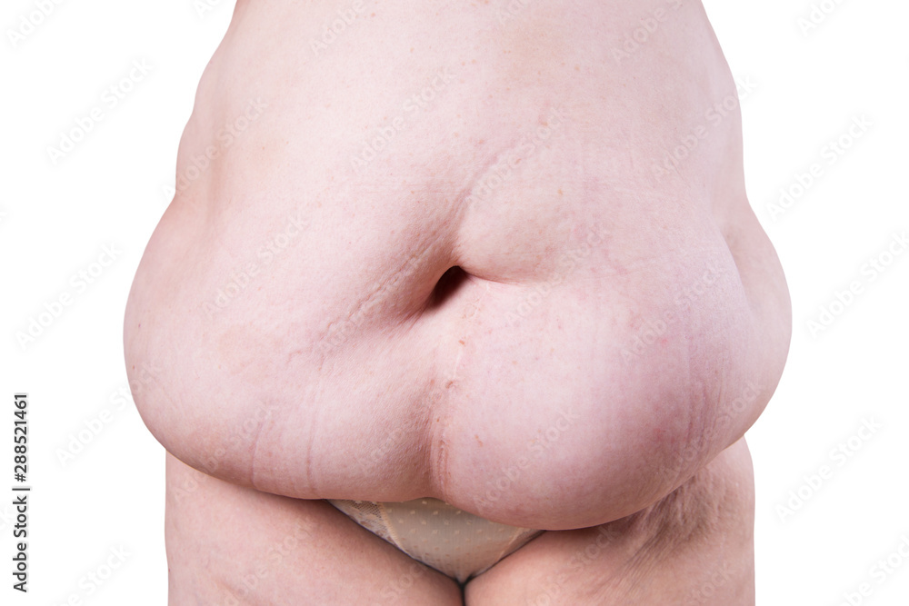 Fototapeta premium Tummy tuck, flabby skin on a fat belly, plastic surgery concept isolated on white background