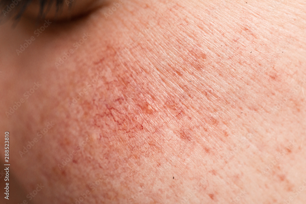 An extreme close up macro view on the superficial dilated blood vessels in the cheek of a young caucasian woman, red lines and blotches symptomatic of rosacea. An extreme close up macro view on the superficial dilated blood vessels in the cheek of a young caucasian woman, red lines and blotches symptomatic of rosacea.