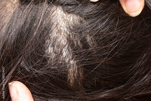A closeup and macro detailed view on the hair parting and scalp of a girl with dark brown hair, fingers are seen pulling the hair apart to check the head.