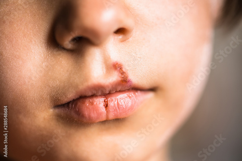 Herpes on upper lip of little girl.  Child with cold sores on her lips.