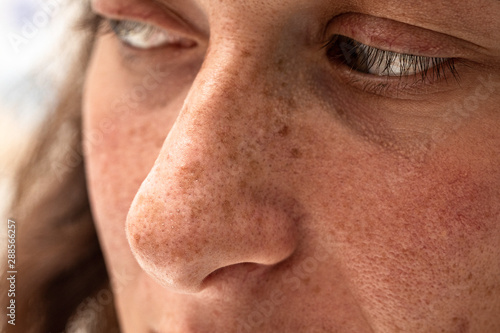 A closeup portrait of a thirty year old caucasian girl, macro details of freckles and sun spots around the nose and cheeks, damage from harmful sun rays.