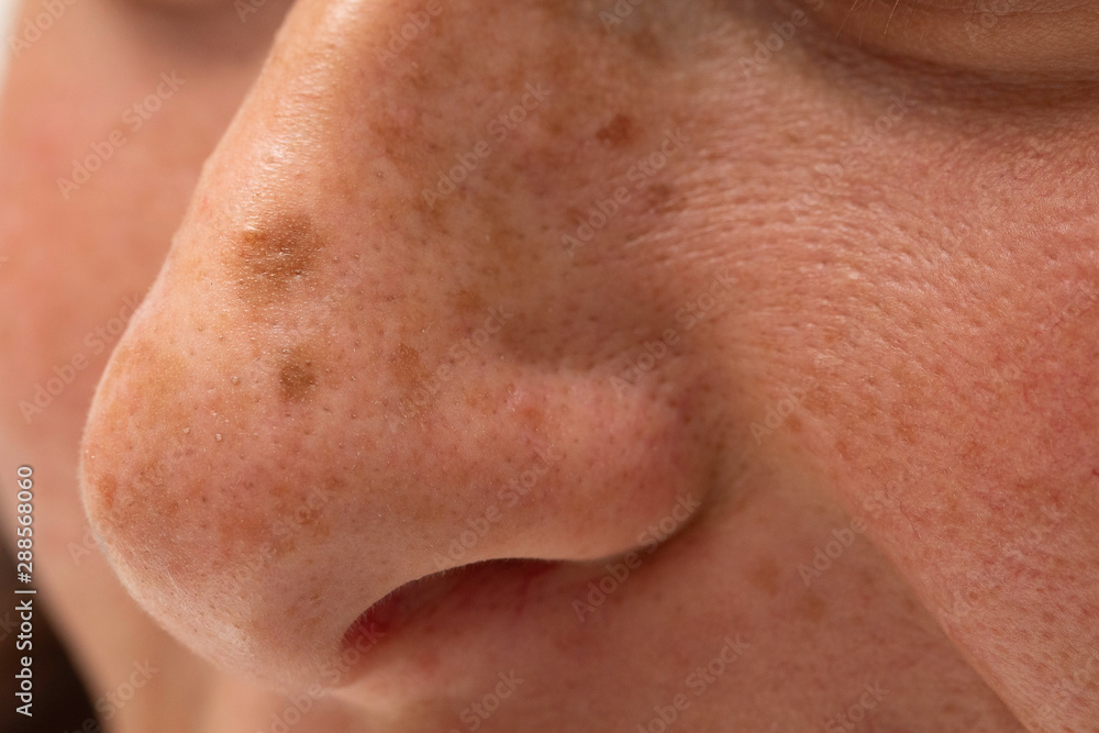 Moles and freckles are seen close up in macro detail, on the nose of a