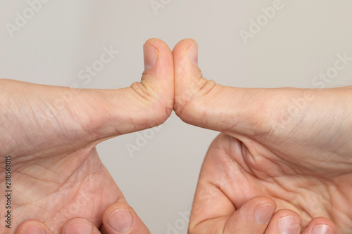 Hypermobile (double-jointed) thumbs are seen close up as a caucasian person shows the flexibility of the thumb joints, bending backwards. photo