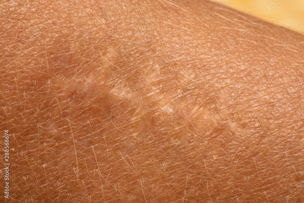 An extreme closeup and detailed view of dry skin around the site of an old injury, with well healed scar from surgical incision through human body. An extreme closeup and detailed view of dry skin around the site of an old injury, with well healed scar from surgical incision through human body.