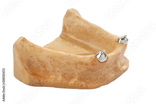 Close up of a Dental implant model,denture on white background, dental plate