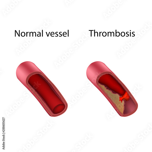 Thrombosis and normal vessel, comparison. Vector medical anatomy illustration.
