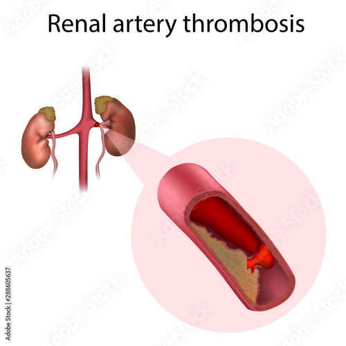 Renal artery thrombosis. Vector medical anatomy illustration.