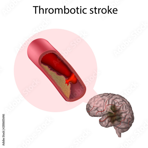 Thrombotic stroke. Brain. Vector medical anatomy illustration.
