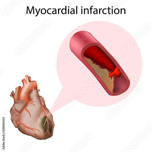 Myocardial infarction. Heart attack. Vector medical anatomy illustration.