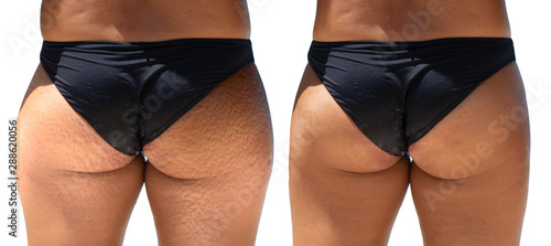 Before and after successful laser surgery treatment for cellulite, heavily pitted skin is seen around the buttocks and thighs of a woman wearing a bikini, confidence is restored with smoothed skin.
