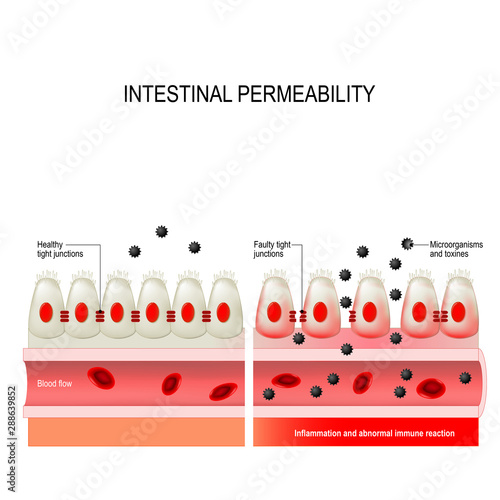 leaky gut. Intestinal permeability
