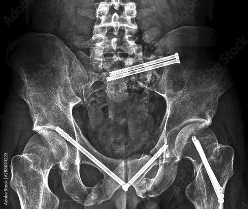 orthopedic fixation of pelvic fracture screws