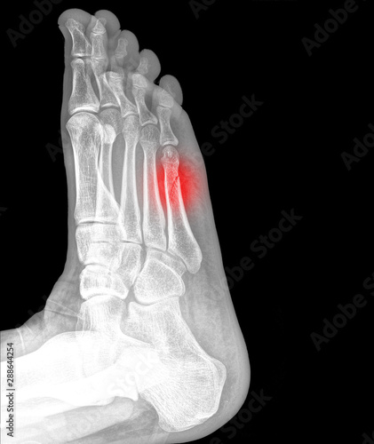 Φωτογραφία X-ray of a metatarsal bone fracture