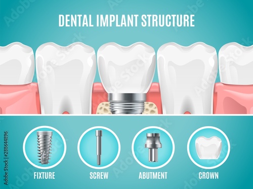 Dental implant structure. Vector reallistic tooth implant cut. Dental surgery banner. Illustration anatomical healthy artificial tooth, dentistry replacement implant photo