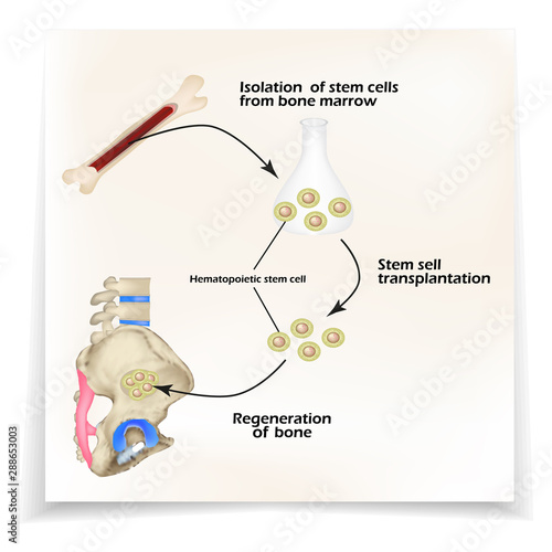 Stem cells from bone marrow are used for bone regeneration. Infographics. Vector illustration