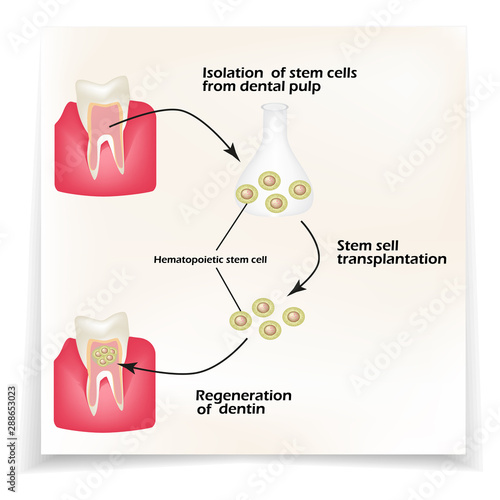 Stem cells from the dentin of the tooth is used to regenerate diseased tooth dentin. Infographics. Vector illustration