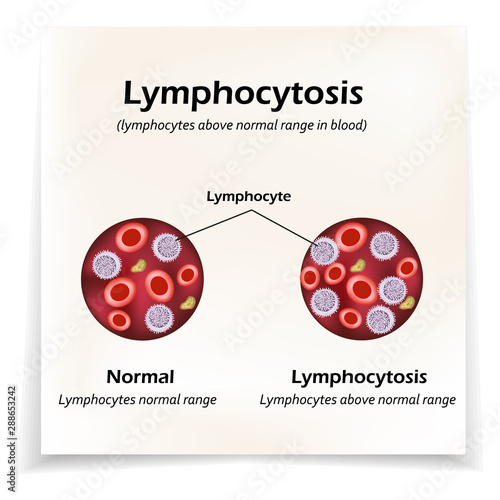 Lymphocytes above the normal range in the blood. Lymphocytosis. Vector illustration