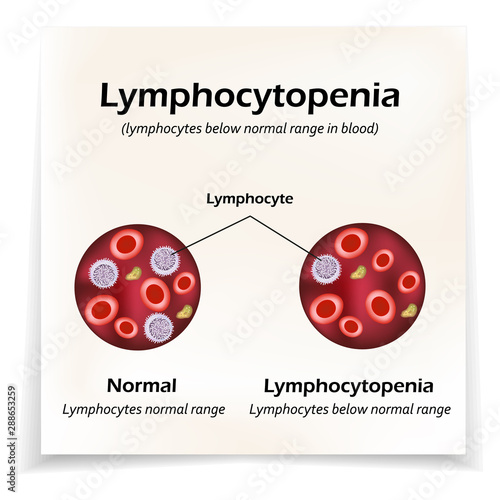 Lymphocytes below the normal range in the blood. Lymphocytopenia. Vector illustration photo