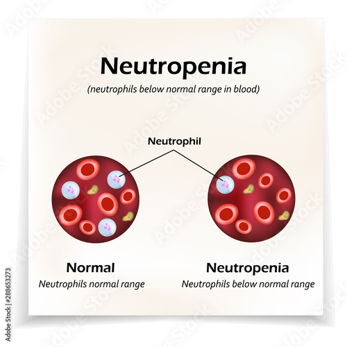 Neutrophils below the normal range in the blood. Neutropenia. Vector illustration