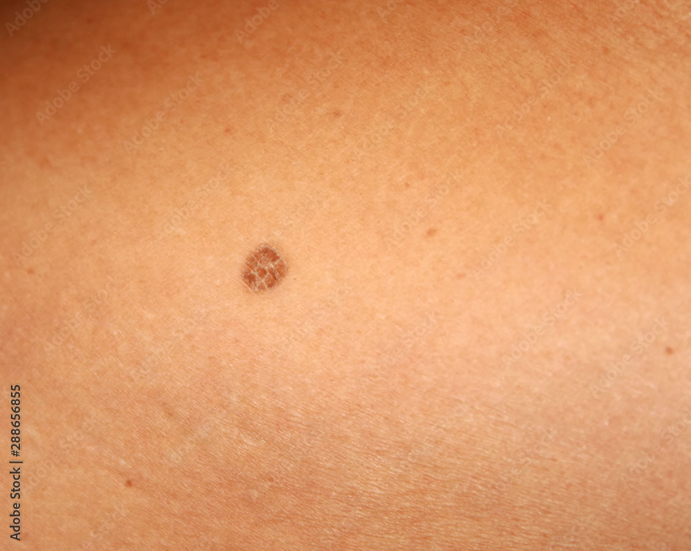 Brown spots on the skin. Spot dark. Stock Photo | Adobe Stock