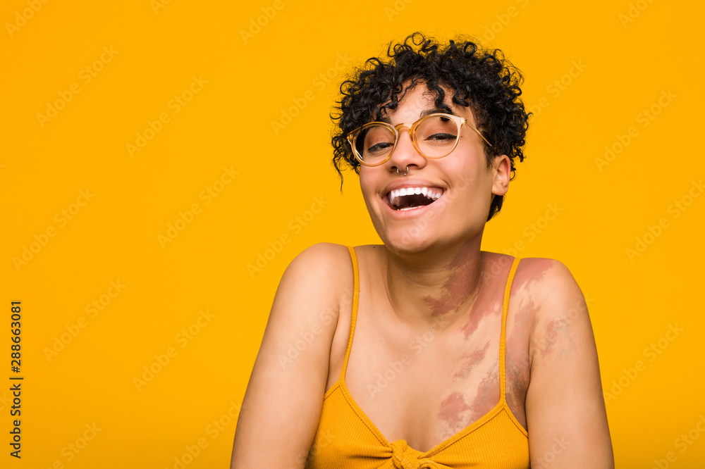 Young african american woman with skin birth mark laughing and having fun. Young african american woman with skin birth mark laughing and having fun.