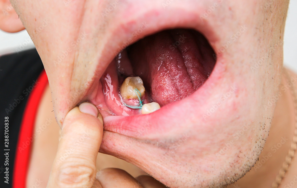 Stitches in the mouth on gums. Teeth implantation. Dental post