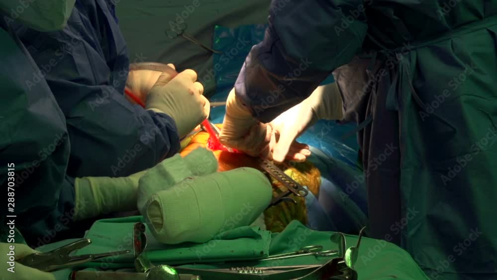 Orthopedic surgery. Hospital. Operating room. Professor, doctor, nurses, surgeon. During a medical operation. In sterile green suits. Orthopedic surgery. Hospital. Operating room. Professor, doctor, nurses, surgeon. During a medical operation. In sterile green suits.