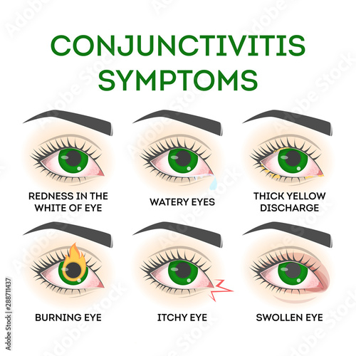 Conjunctivitis symptoms. Pink eye disease, infection and allergy