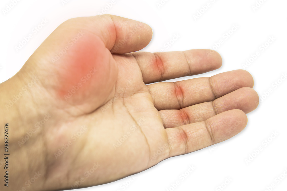 Rheumatoid Arthritis Rheumatoid Arthritis