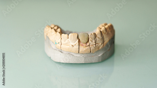 Cast of the lower jaw of a person. Installation of veneers. Dental prosthetics. Health care concept. Close-up shot