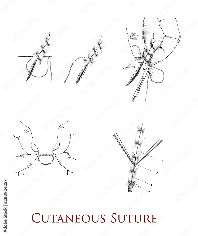 Surgery and medicine cutaneous suture, techniques for the closure of