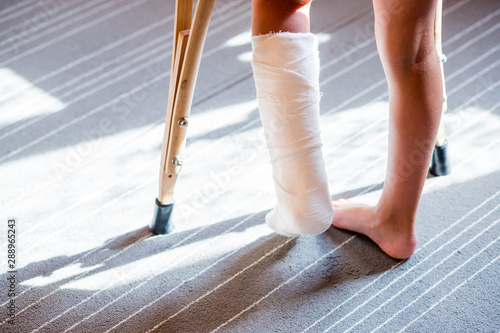 girl with a broken leg .close-up of feet, one with a plaster bandage. foot splint for treatment of injuries from broken bones. ankle sprain after jumping on the trampoline