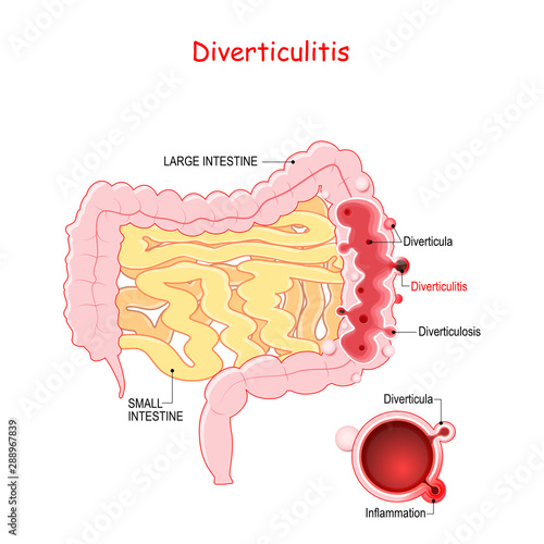 Diverticulosis and Diverticulitis photo