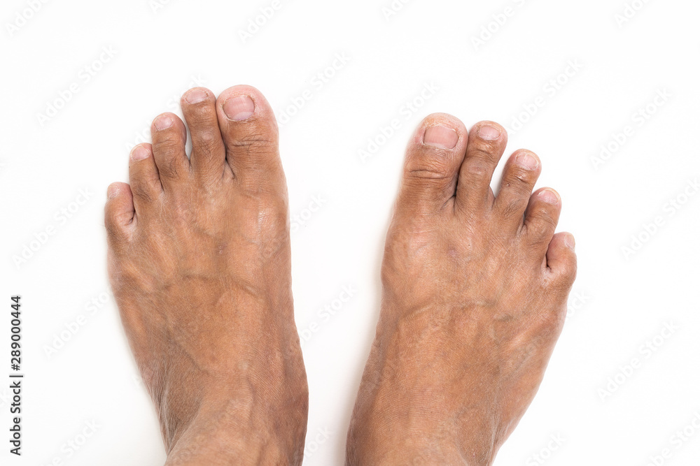 Asian man foot brown and dry skin Asian man foot brown and dry skin
