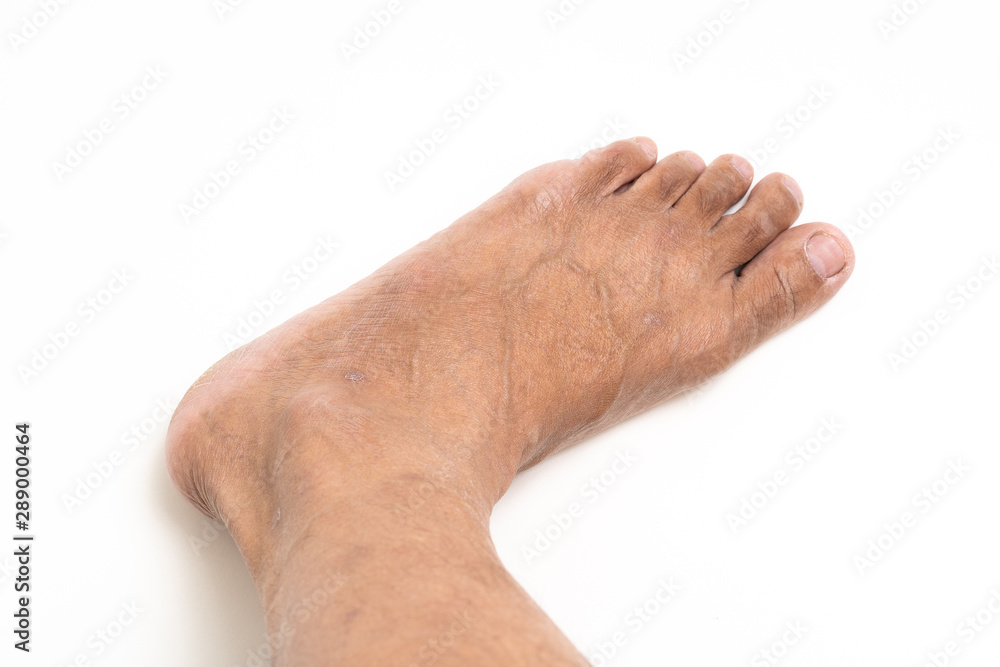 Asian man foot brown and dry skin Asian man foot brown and dry skin