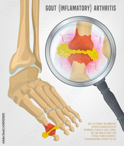 Gout arthritis image photo