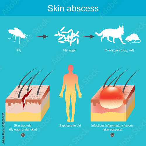 Skin abscess. Inflammation of the skin resulting from pathogens entering open skin wounds.