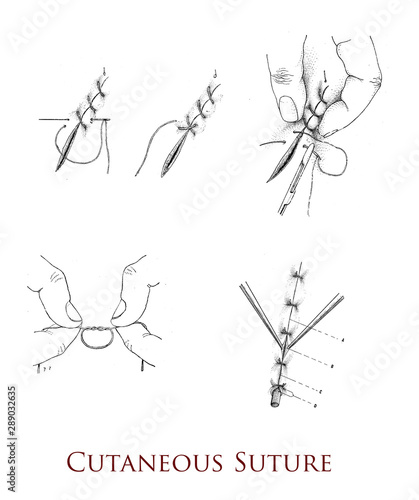 Surgery and medicine - cutaneous suture, techniques for  the closure of a wound  using a thread attached to a needle with knots tied to maintain the apposition of wound edges photo