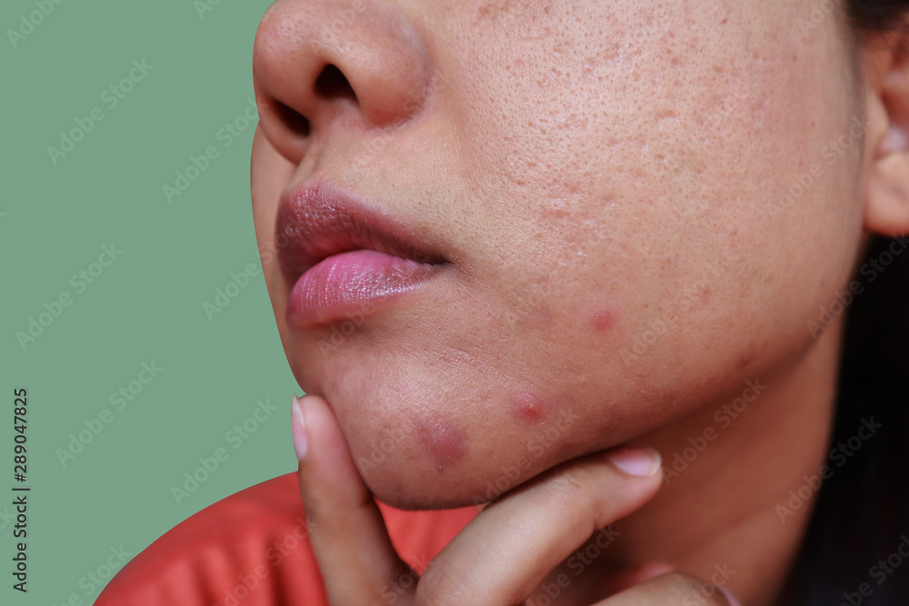 Pustules whitehead acne from face, Problems with acne and scar on the female skin, Skin problem Pustules whitehead acne from face, Problems with acne and scar on the female skin, Skin problem