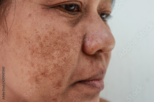 Skin problem, Closeup skin face asian women with spot melasma,  Dark spots, freckles, pigmentation  Skincare problem concept. photo