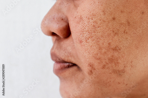 Skin problem, skin face asian women with spot melasma,  Dark spots, freckles, pigmentation  Skincare problem concept. photo