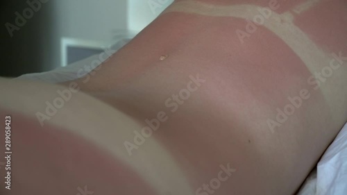 Young woman with red sunburned skin on her back. Putting sunburn lotion on the back. Red sunburned skin.