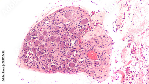 Histology of a peripheral nerve ganglion.  Ganglia such as this are commonly present as incidental findings in prostate core biopsies.  photo