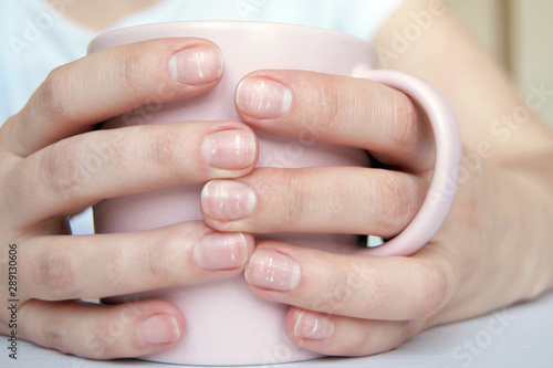 Fotografia, Obraz Many white spots on fingernails ( Leukonychia ) due to calcium deficit or stress