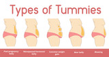 Types of female tummies banner. Tummy tuck surgery or abdominoplasty vector illustration. Medical advertising of cosmetic plastic procedures.