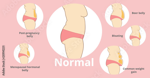 Types of female tummies banner. Tummy tuck surgery or abdominoplasty vector illustration. Medical advertising of cosmetic plastic procedures.