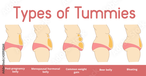 Types of female tummies banner. Tummy tuck surgery or abdominoplasty vector illustration. Medical advertising of cosmetic plastic procedures.