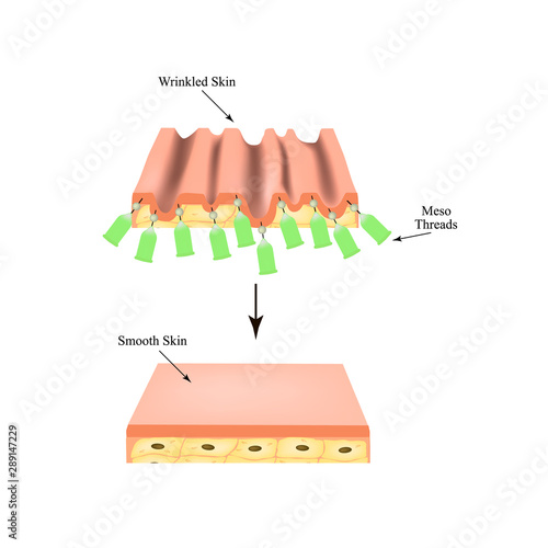 Mesotherapy Threads Lifting. threads for facelift. The structure of the skin. Wrinkles. Infographics. Vector illustration on isolated background.