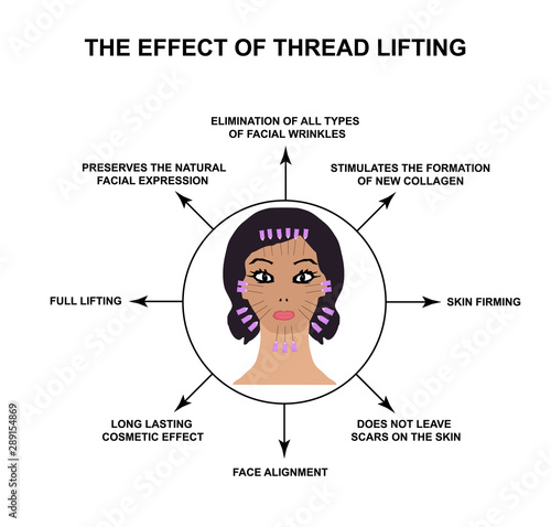 The effect of thread lifting. Threads for a facelift. Mesotherapy Wrinkles. Infographics. Vector illustration on isolated background.