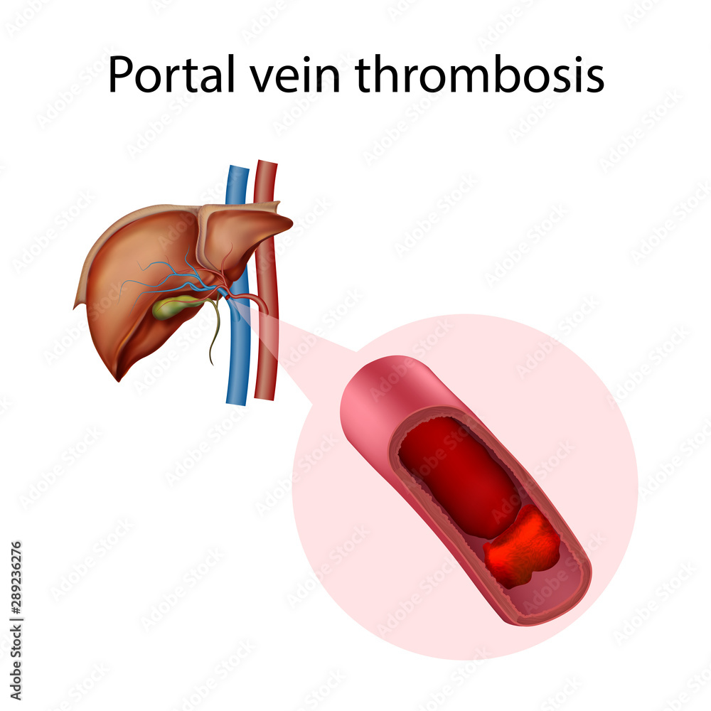 Portal Vein Thrombosis Vector Medical Anatomy Illustration Vector De portal-vein-thrombosis-vector-medical-anatomy-illustration-vector-de